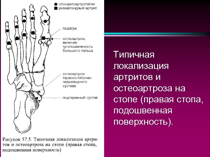 Типичная локализация артритов и остеоартроза на стопе (правая стопа, подошвенная поверхность). 