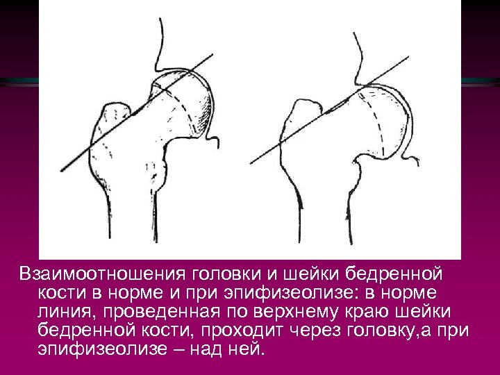 Карта вызова смп перелом бедренной кости