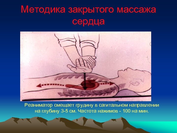 Методика закрытого массажа сердца Реаниматор смещает грудину в сагитальном направлении на глубину 3 -5
