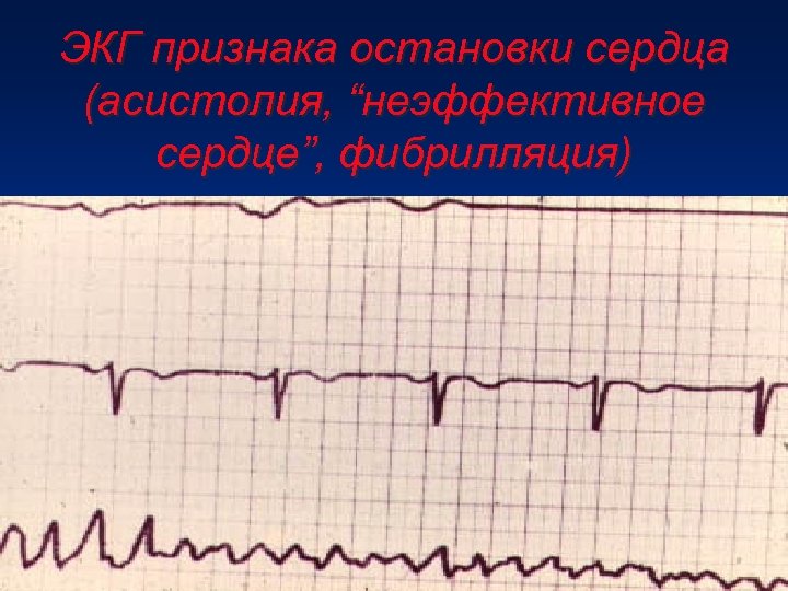 Асистолия на экг фото