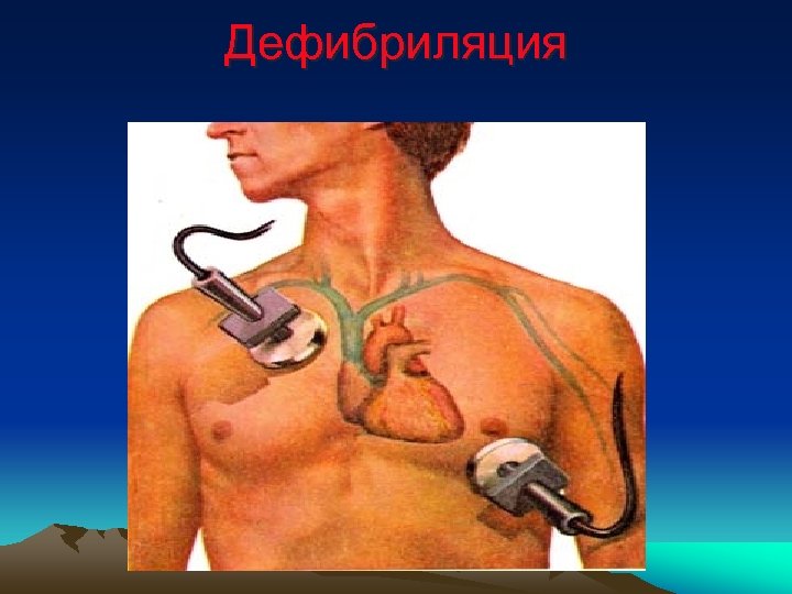 Дефибриляция 