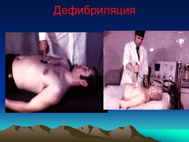 Дефибриляция 