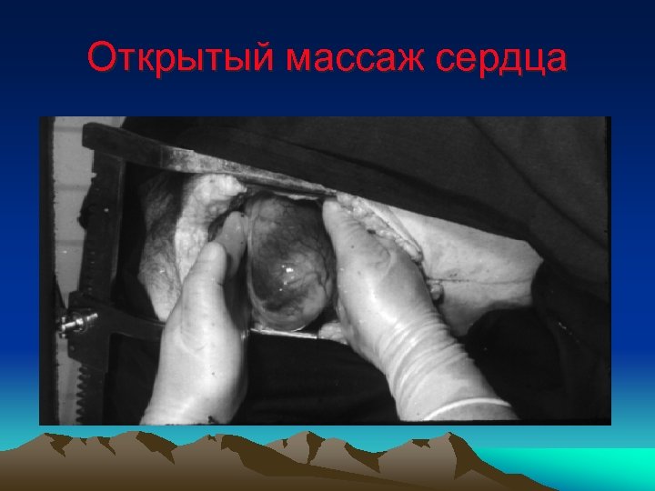 Открытый массаж сердца 
