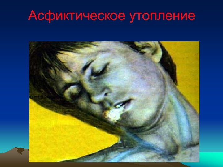 Асфиктическое утопление 