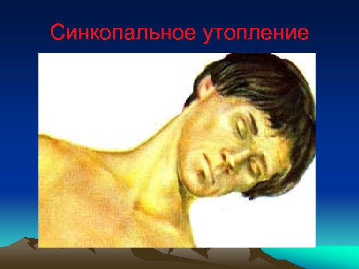 Синкопальное утопление 