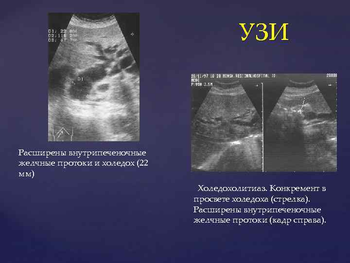 УЗИ Расширены внутрипеченочные желчные протоки и холедох (22 мм) Холедохолитиаз. Конкремент в просвете холедоха