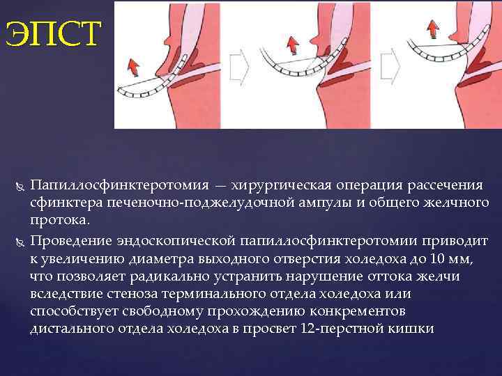 ЭПСТ Папиллосфинктеротомия — хирургическая операция рассечения сфинктера печеночно поджелудочной ампулы и общего желчного протока.