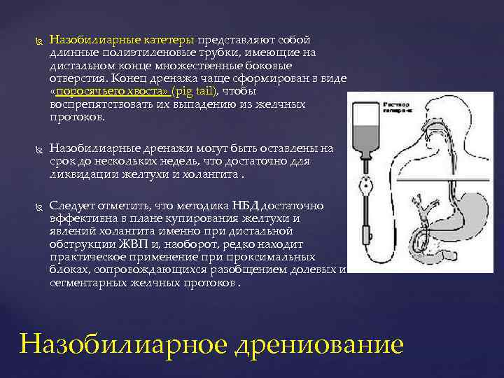  Назобилиарные катетеры представляют собой длинные полиэтиленовые трубки, имеющие на дистальном конце множественные боковые