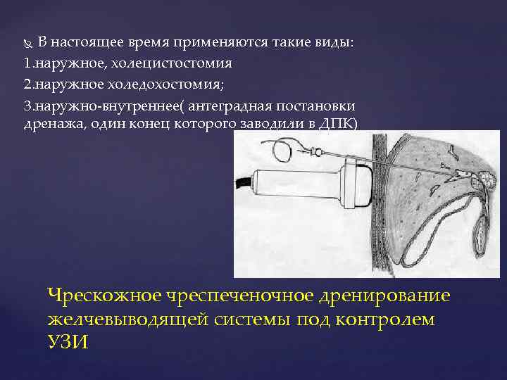 В настоящее время применяются такие виды: 1. наружное, холецистостомия 2. наружное холедохостомия; 3. наружно