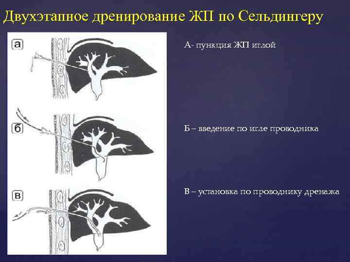 Двухэтапное дренирование ЖП по Сельдингеру А пункция ЖП иглой Б – введение по игле