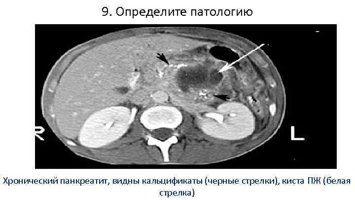 9. Определите патологию Хронический панкреатит, видны кальцификаты (черные стрелки), киста ПЖ (белая стрелка) 