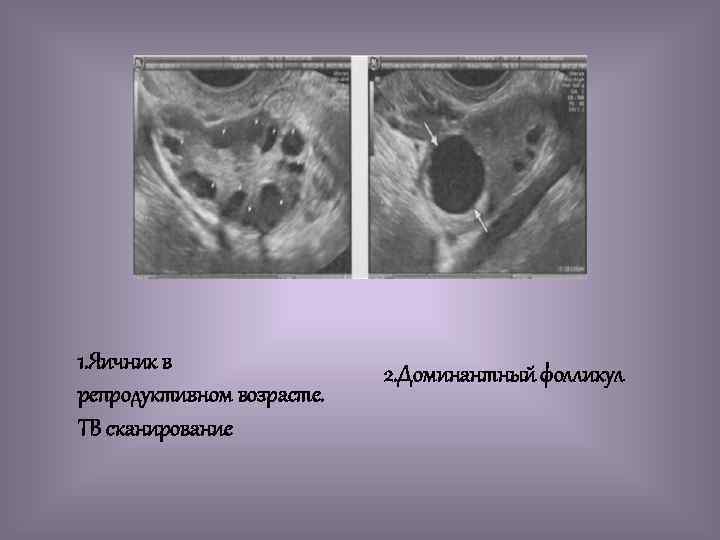 Доминантный фолликул фото