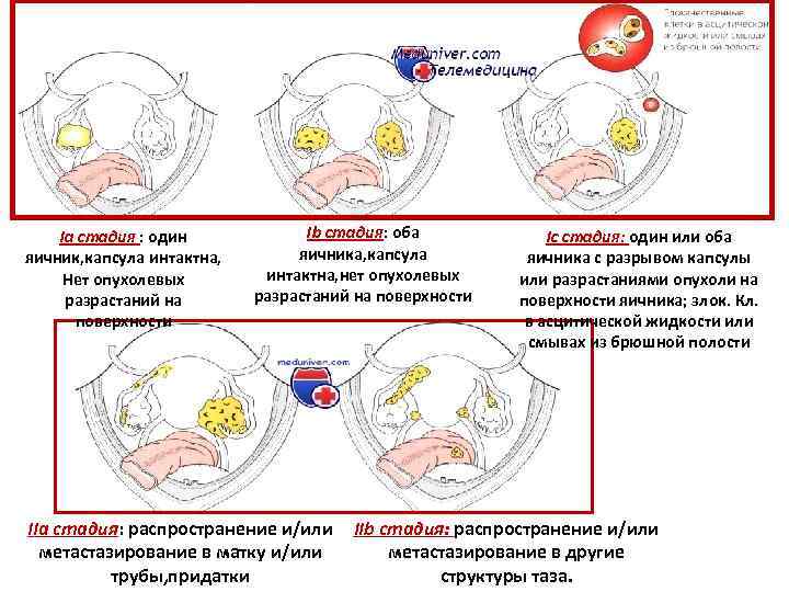 Ia стадия : один яичник, капсула интактна, Нет опухолевых разрастаний на поверхности Ib стадия: