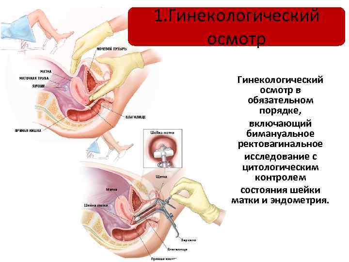 1. Гинекологический осмотр в обязательном порядке, включающий бимануальное ректовагинальное исследование с цитологическим контролем состояния