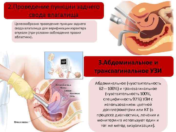 2. Проведение пункции заднего свода влагалища Целесообразно проведение пункции заднего свода влагалища для верификации