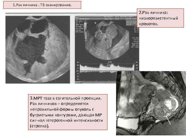 1. Рак яичника. ТВ сканирование. 2. Рак яичника: низкорезистентный кровоток. 3. МРТ таза в