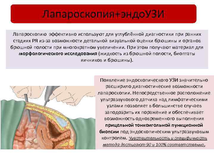Лапароскопия+эндо. УЗИ Лапароскопию эффективно используют для углублённой диагностики при ранних стадиях РЯ из-за возможности
