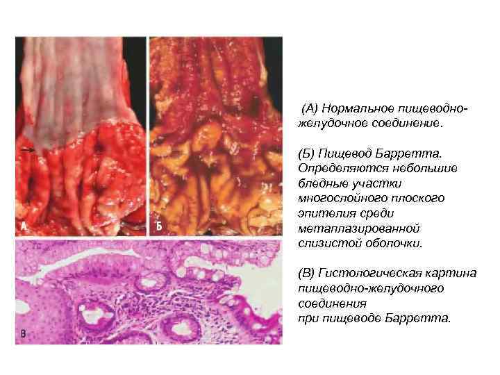 (А) Нормальное пищеводножелудочное соединение. (Б) Пищевод Барретта. Определяются небольшие бледные участки многослойного плоского эпителия