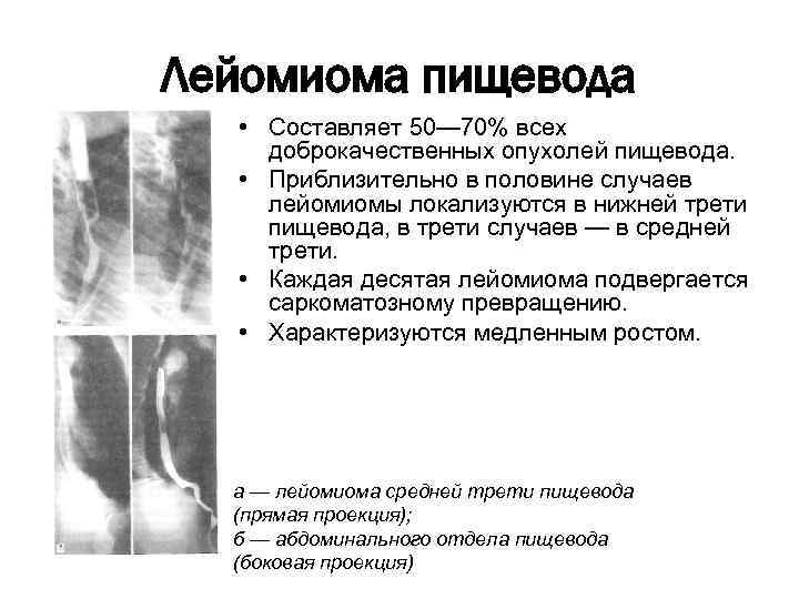 Лейомиома пищевода • Составляет 50— 70% всех доброкачественных опухолей пищевода. • Приблизительно в половине