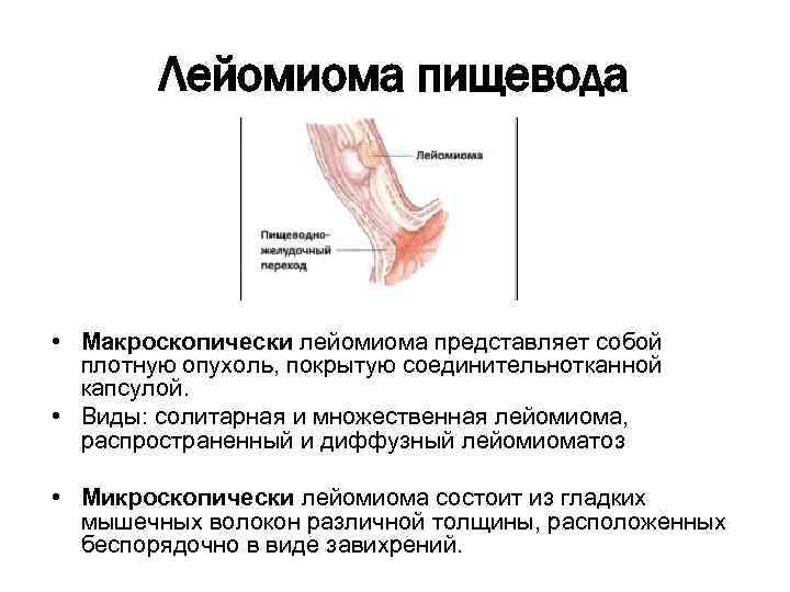 Лейомиома пищевода • Макроскопически лейомиома представляет собой плотную опухоль, покрытую соединительнотканной капсулой. • Виды: