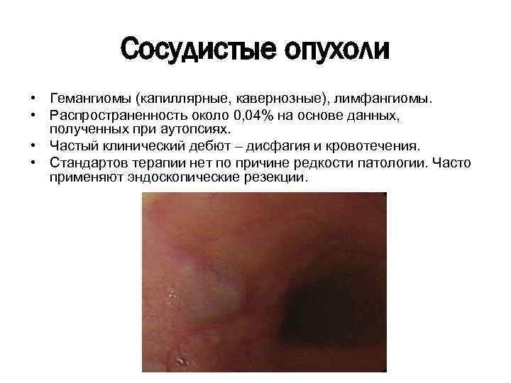 Сосудистые опухоли • Гемангиомы (капиллярные, кавернозные), лимфангиомы. • Распространенность около 0, 04% на основе