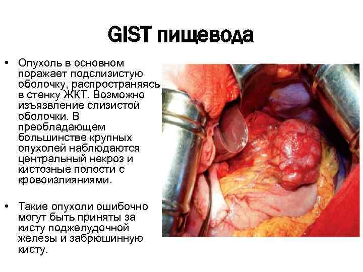 GIST пищевода • Опухоль в основном поражает подслизистую оболочку, распространяясь в стенку ЖКТ. Возможно