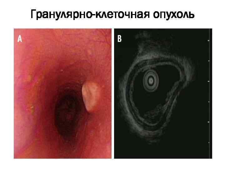 Гранулярно-клеточная опухоль 