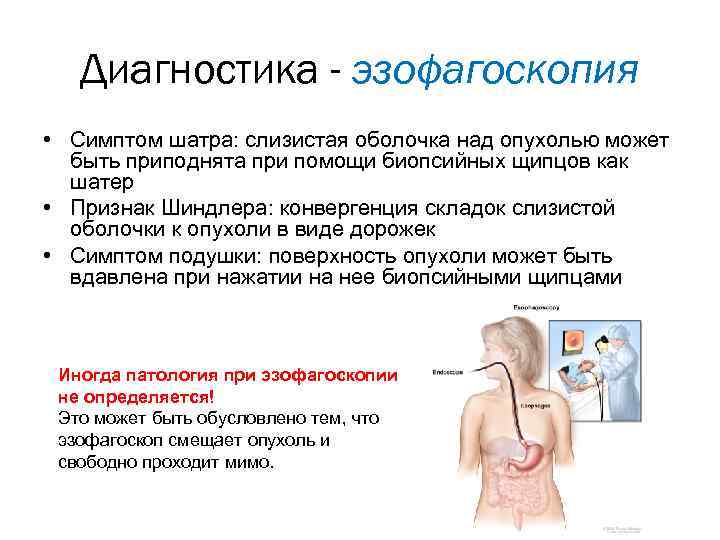 Диагностика - эзофагоскопия • Симптом шатра: слизистая оболочка над опухолью может быть приподнята при