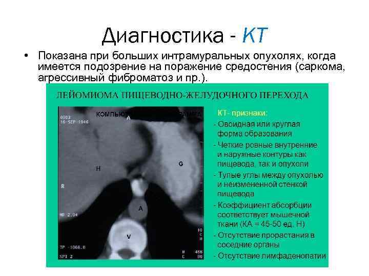 Диагностика - КТ • Показана при больших интрамуральных опухолях, когда имеется подозрение на поражение