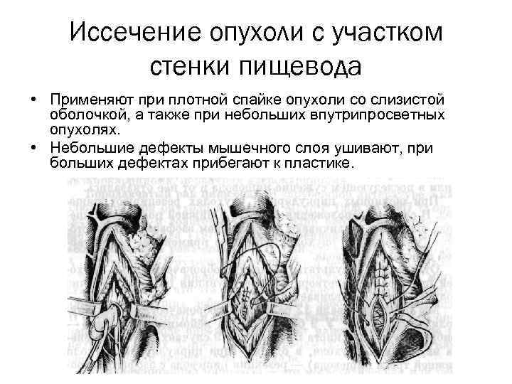 Иссечение опухоли с участком стенки пищевода • Применяют при плотной спайке опухоли со слизистой