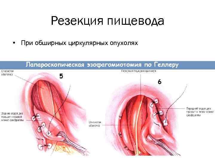 Резекция пищевода • При обширных циркулярных опухолях 
