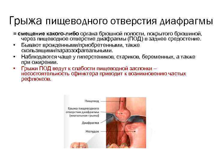 Грыжа пищеводного отверстия диафрагмы = смещение какого-либо органа брюшной полости, покрытого брюшиной, через пищеводное