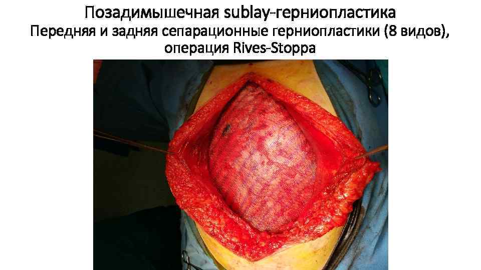 Позадимышечная sublay-герниопластика Передняя и задняя сепарационные герниопластики (8 видов), операция Rives-Stoppa 