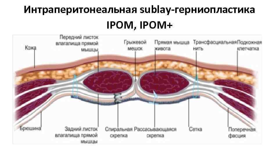 Интраперитонеальная sublay герниопластика IPOM, IPOM+ 