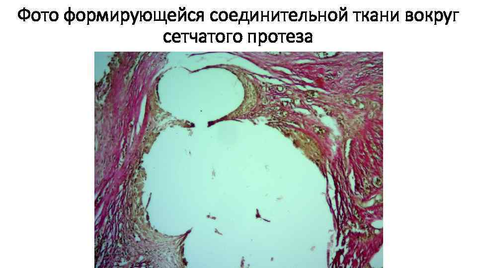 Фото формирующейся соединительной ткани вокруг сетчатого протеза 