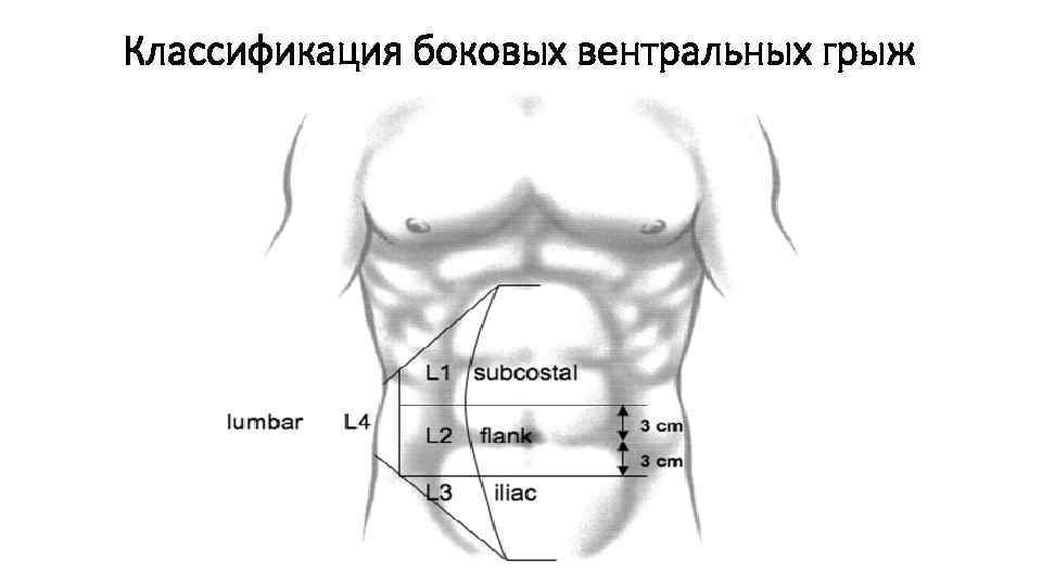 Классификация боковых вентральных грыж 