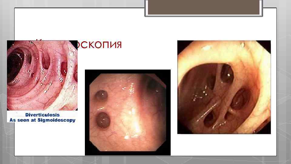 Колоноскопия 