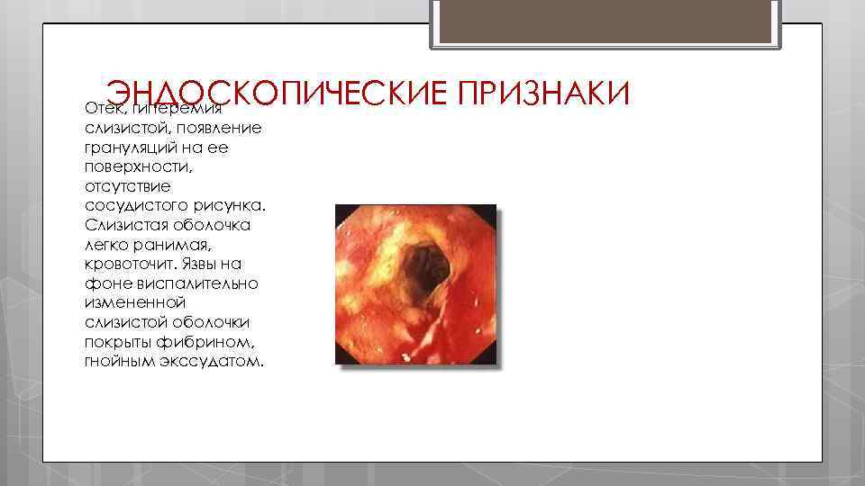 ЭНДОСКОПИЧЕСКИЕ ПРИЗНАКИ Отек, гиперемия слизистой, появление грануляций на ее поверхности, отсутствие сосудистого рисунка. Слизистая