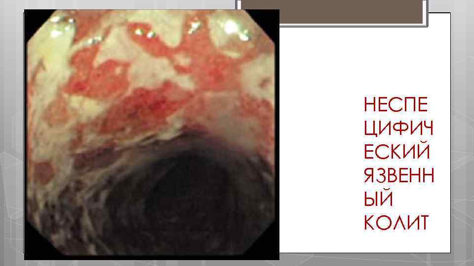 НЕСПЕ ЦИФИЧ ЕСКИЙ ЯЗВЕНН ЫЙ КОЛИТ 