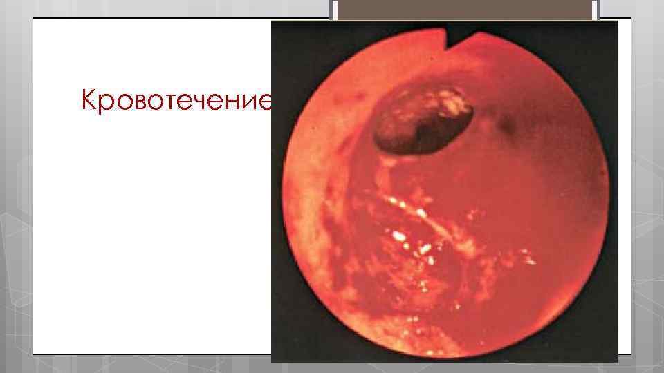 Кровотечение 