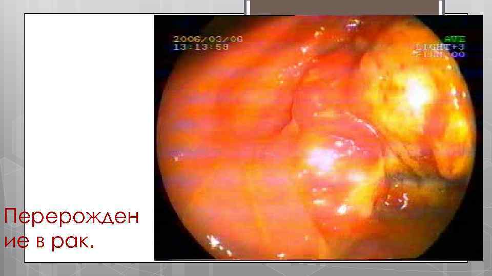 Перерожден ие в рак. 