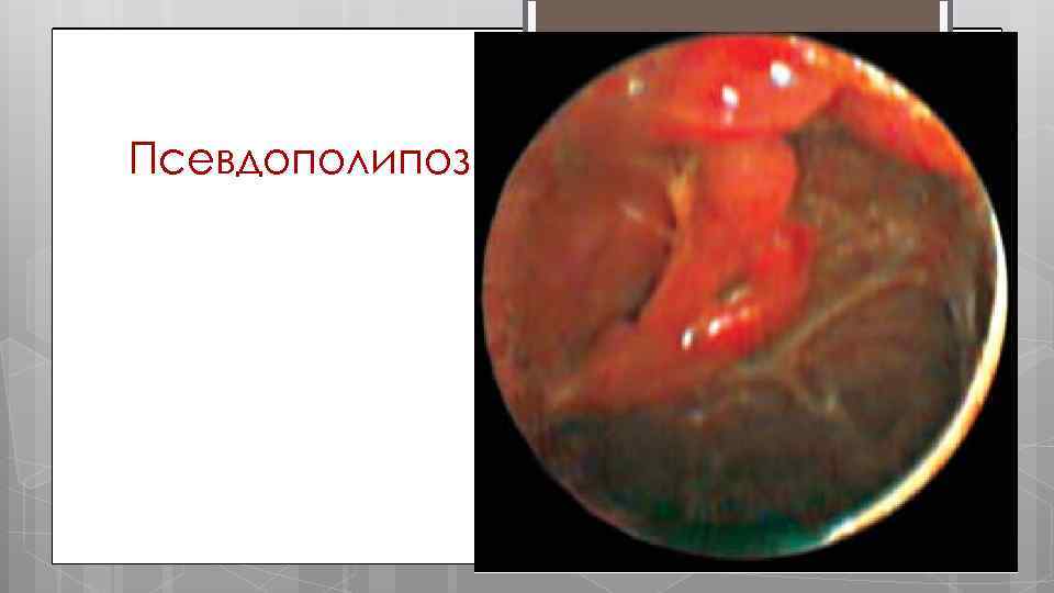 Псевдополипоз 
