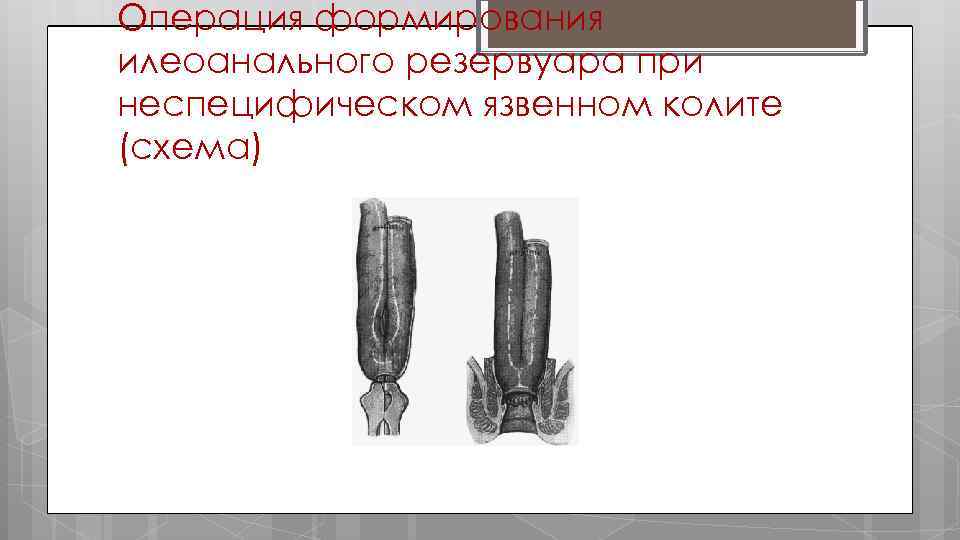 Операция формирования илеоанального резервуара при неспецифическом язвенном колите (схема) 
