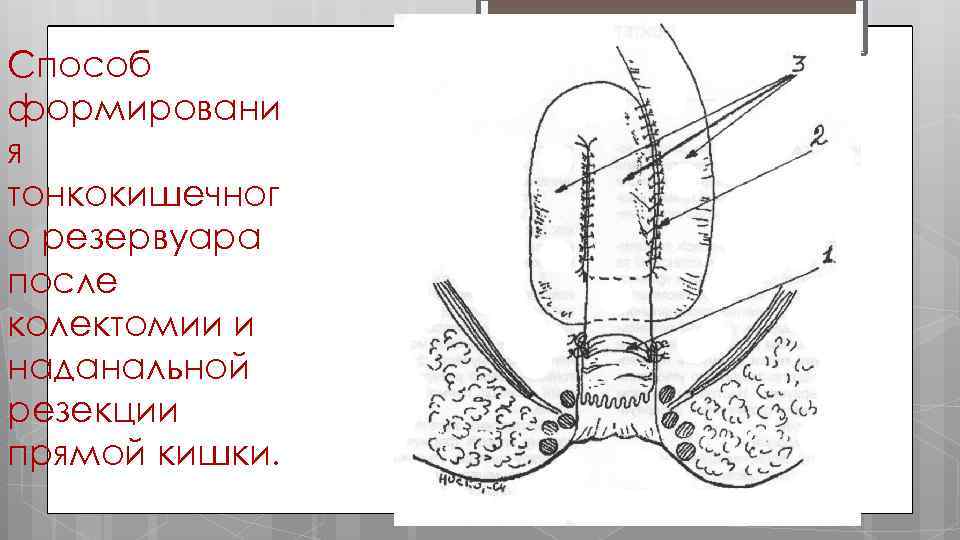 Способ формировани я тонкокишечног о резервуара после колектомии и наданальной резекции прямой кишки. 