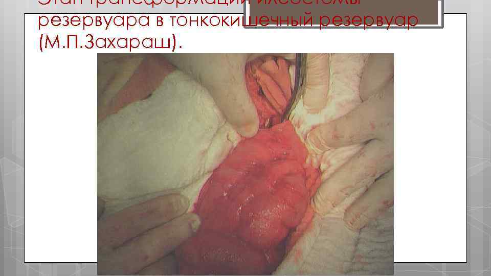 Этап трансформации илеостомы резервуара в тонкокишечный резервуар (М. П. Захараш). 