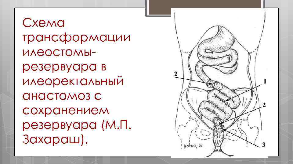 Схема трансформации илеостомы резервуара в илеоректальный анастомоз с сохранением резервуара (М. П. Захараш). 