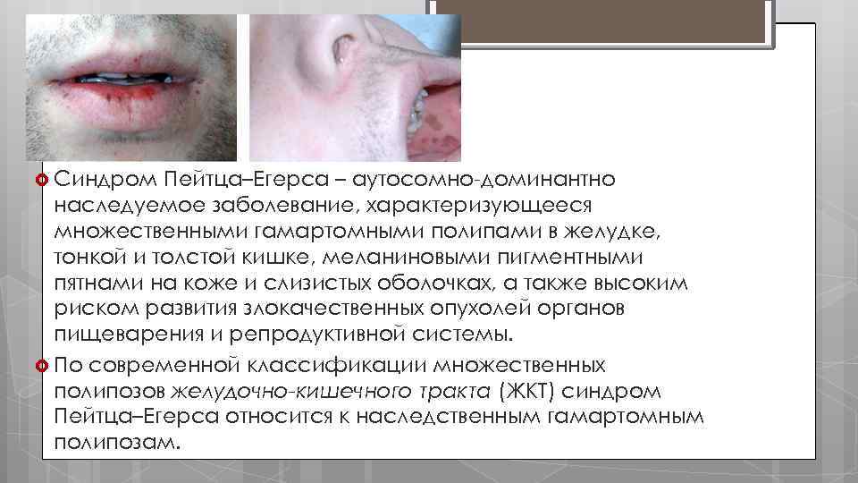  Синдром Пейтца–Егерса – аутосомно доминантно наследуемое заболевание, характеризующееся множественными гамартомными полипами в желудке,