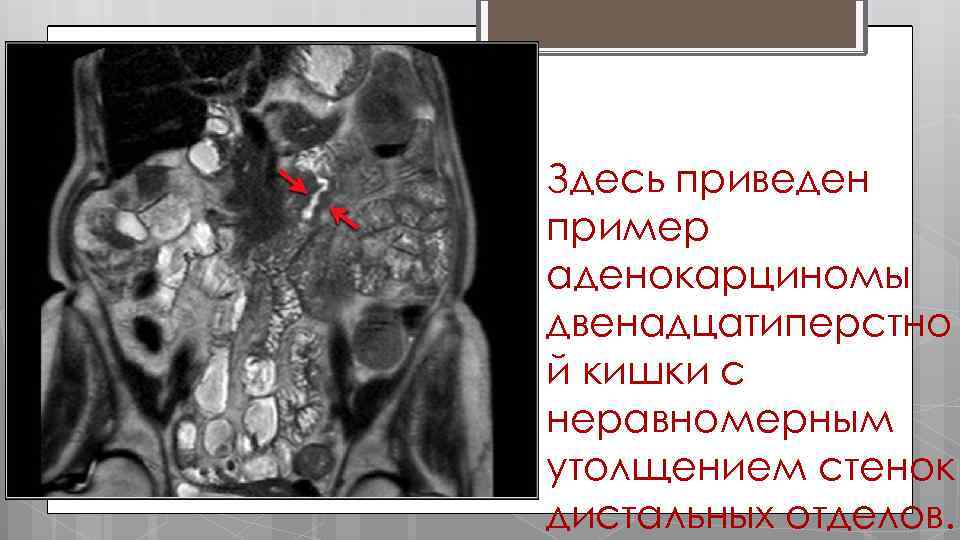 Здесь приведен пример аденокарциномы двенадцатиперстно й кишки с неравномерным утолщением стенок дистальных отделов. 