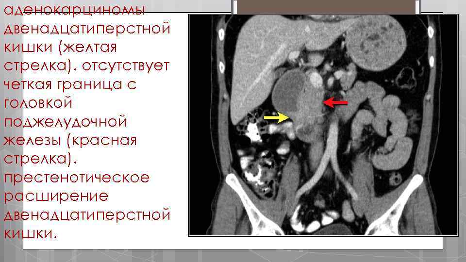 аденокарциномы двенадцатиперстной кишки (желтая стрелка). отсутствует четкая граница с головкой поджелудочной железы (красная стрелка).
