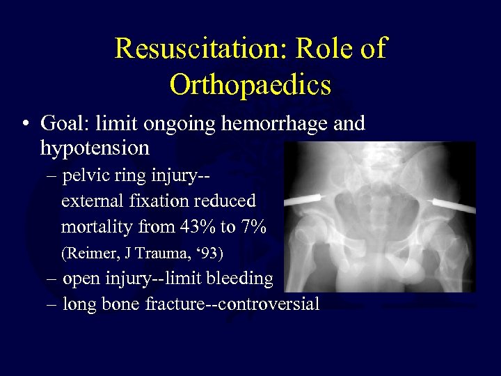 Resuscitation: Role of Orthopaedics • Goal: limit ongoing hemorrhage and hypotension – pelvic ring